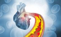 New cholesterol guideline expands treatment eligibility to 55% of U.S. adults