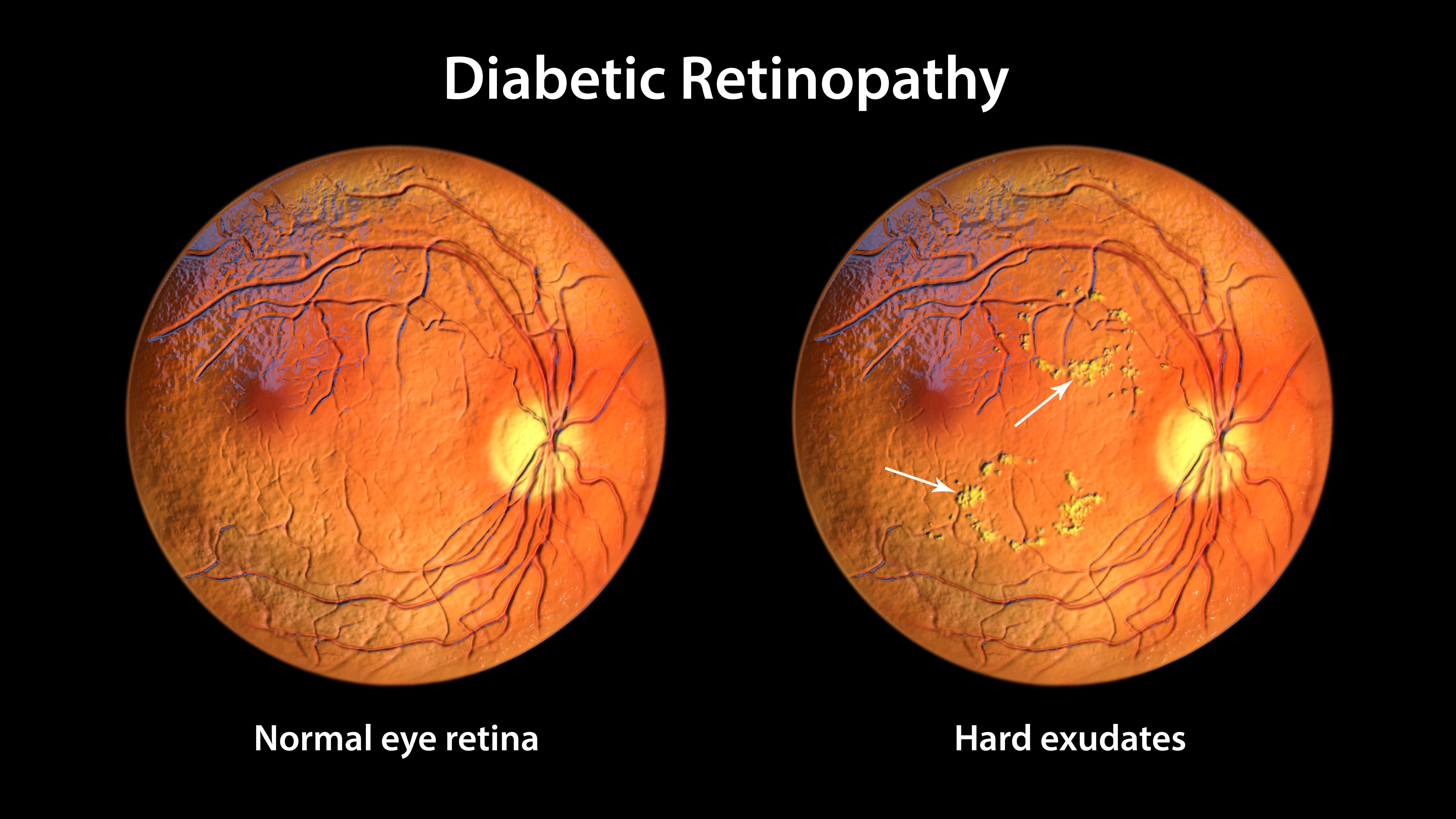 glp 1 and eye issues The Link between GLP-1 Drugs and Diabetic Retinopathy Is Not So Clear | AAO  2024