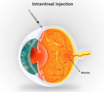 Illustration of intravitreal injection | Image credit: © AngelaSouza stock.adobe.com