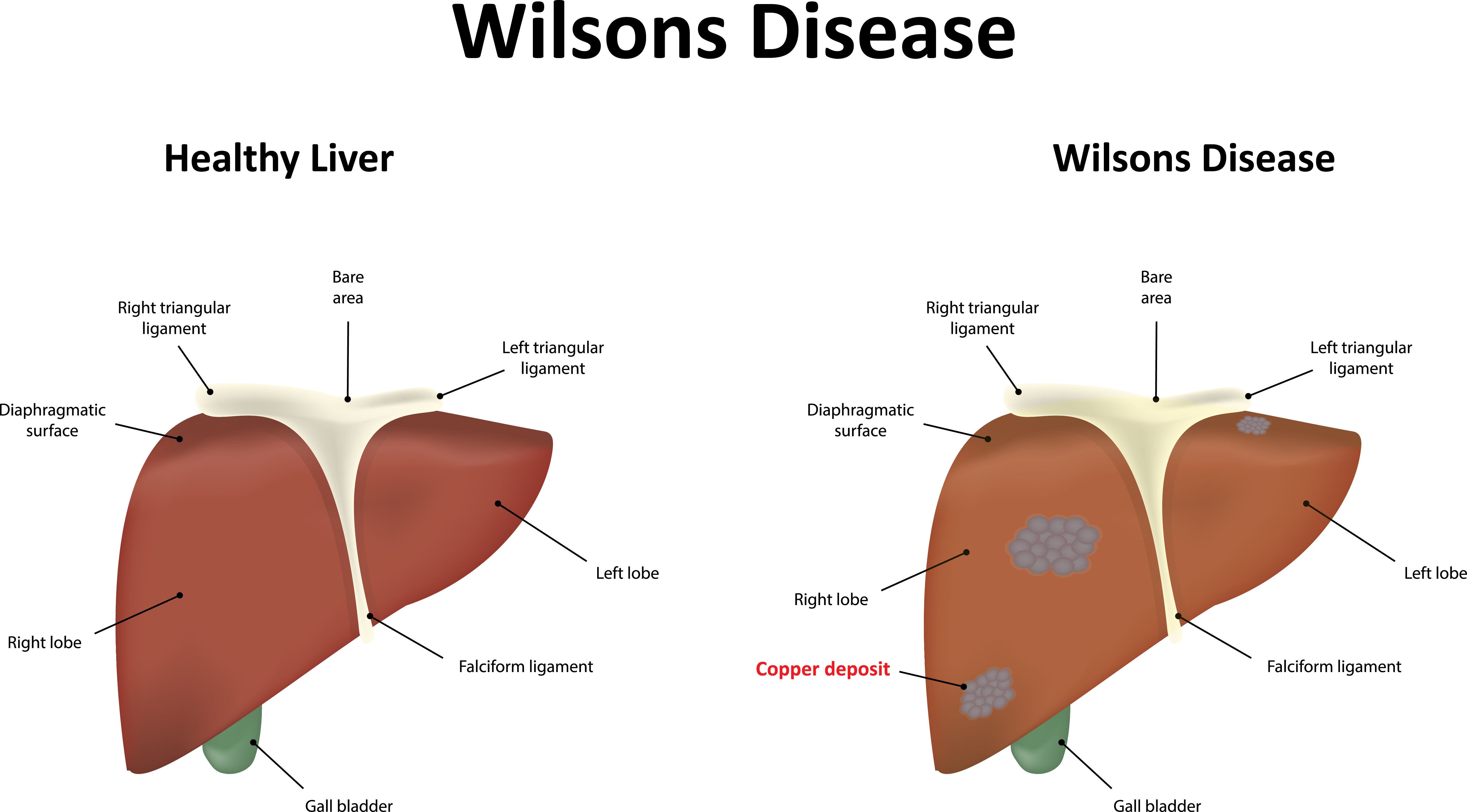 Gene Therapy Among The New Possible Treatments For Wilson’s Disease, A ...