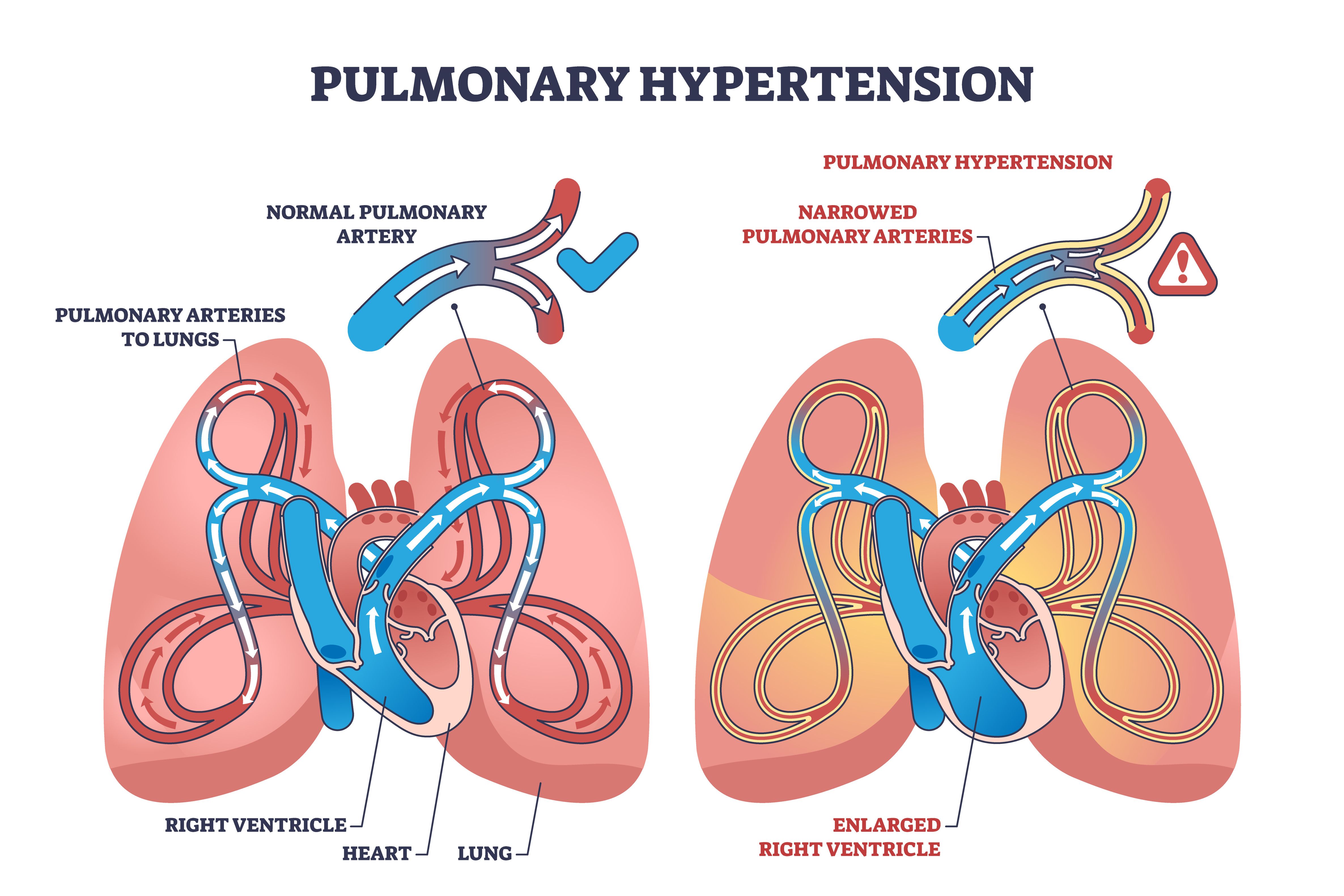 FDA Approves Combination Therapy for PAH