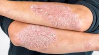 Stressful Family Changes in Early Childhood Could Increase Psoriasis Risk