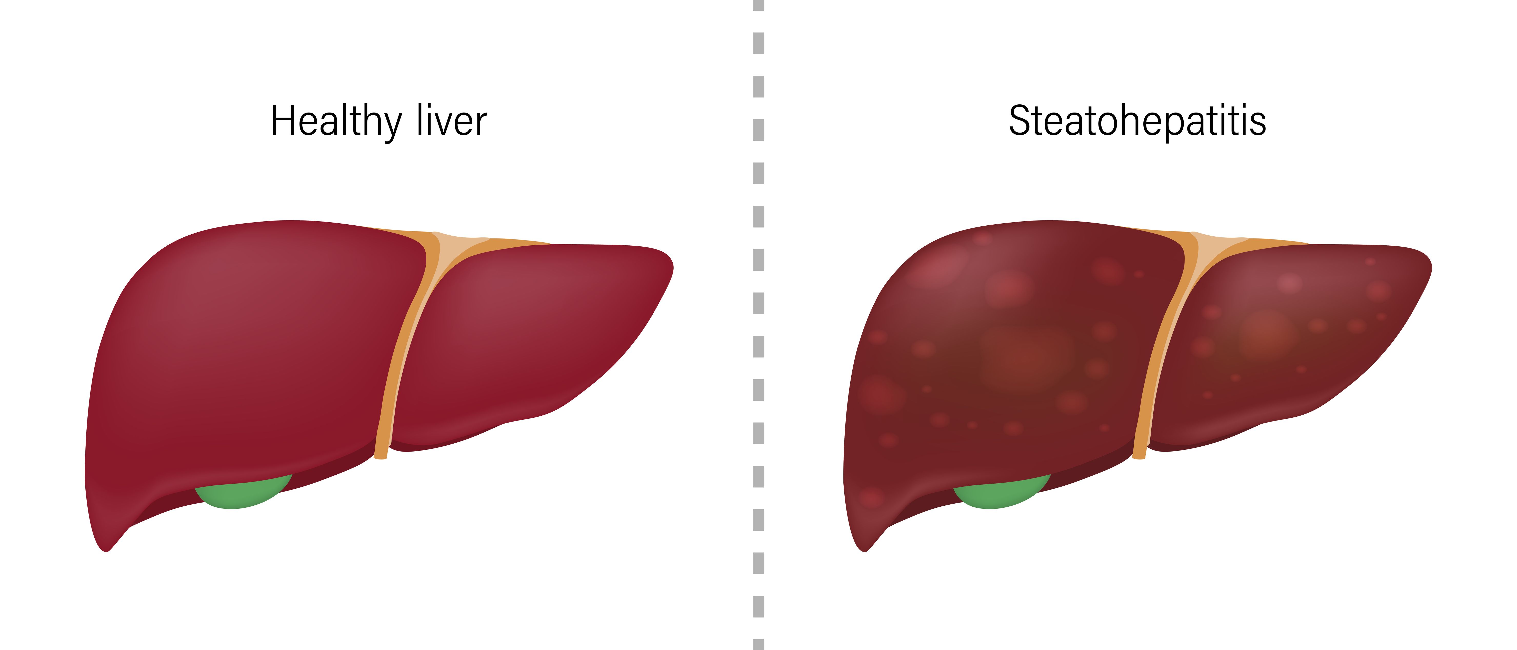 FDA Sets PDUFA Date for Drug to Treat Patients with NASH