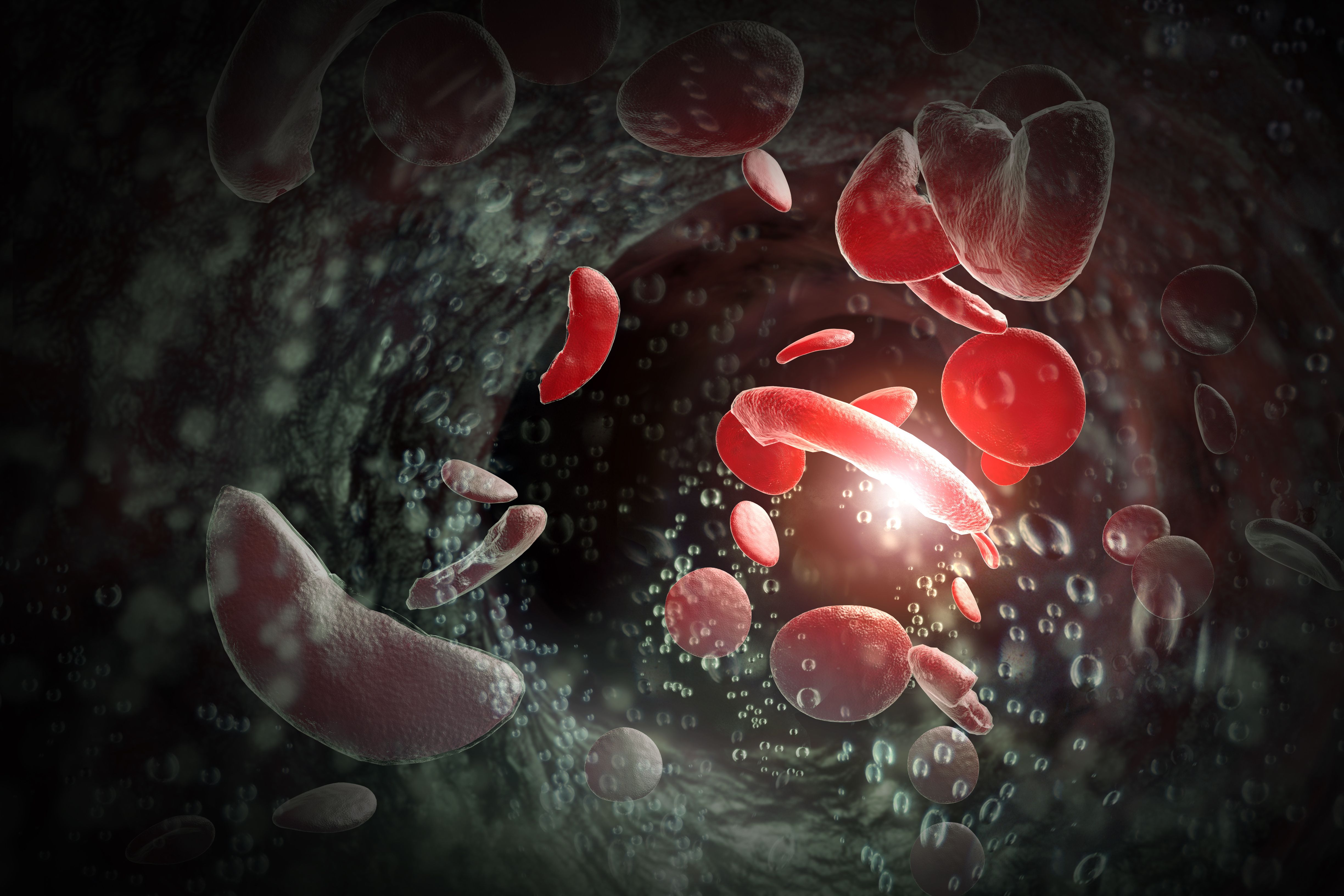 Sickle cell anemia illustration | Image credits: @Ezume Images stock.adobe.com