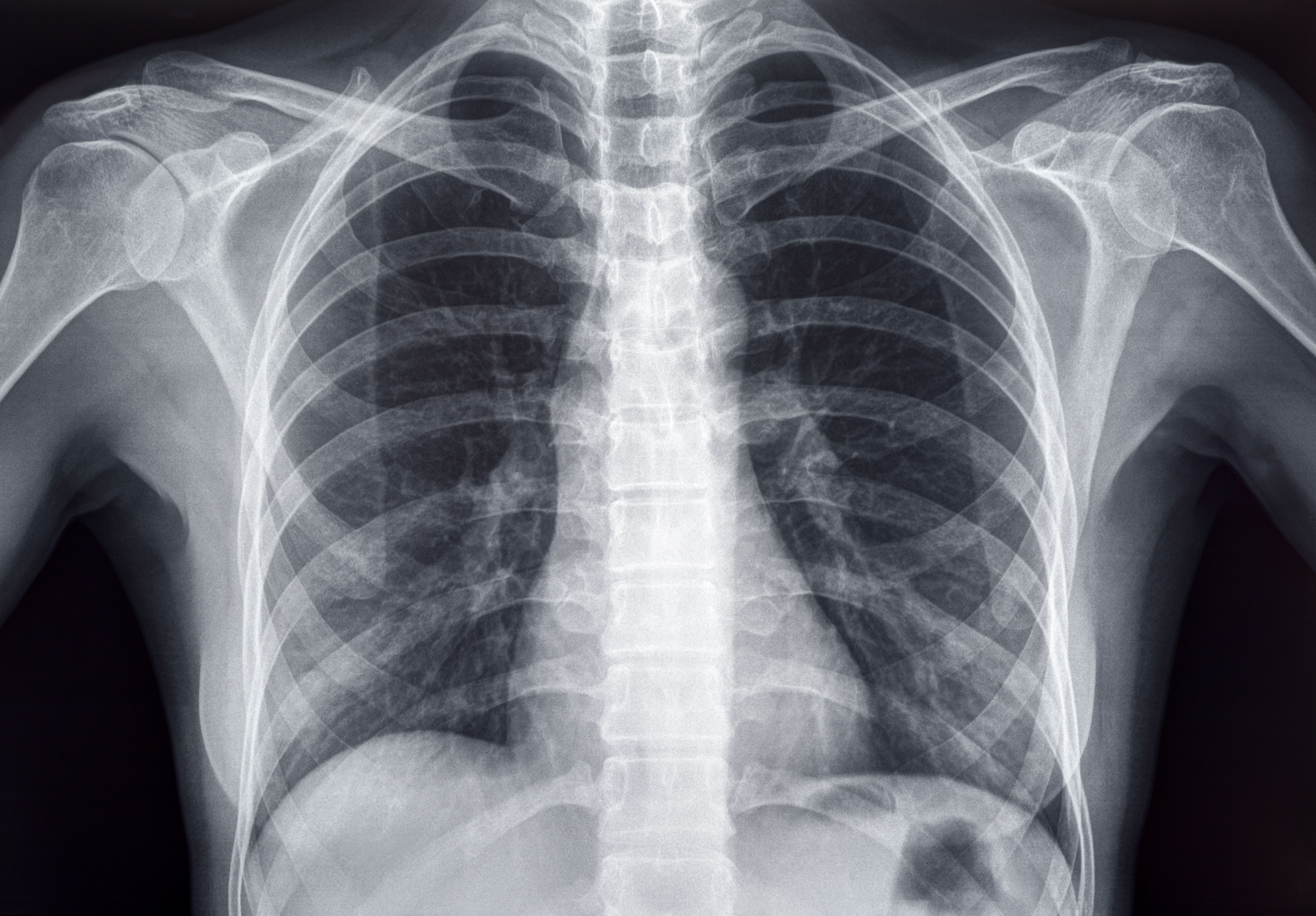Black and white chest X-ray | ©Photoedit stock.adobe.com