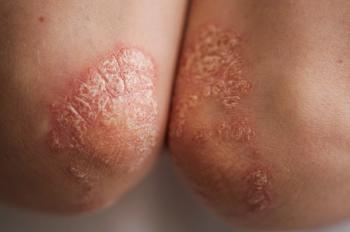 Close up of psoriasis | Image credit: © vadim yerofeyev stock.adobe.com