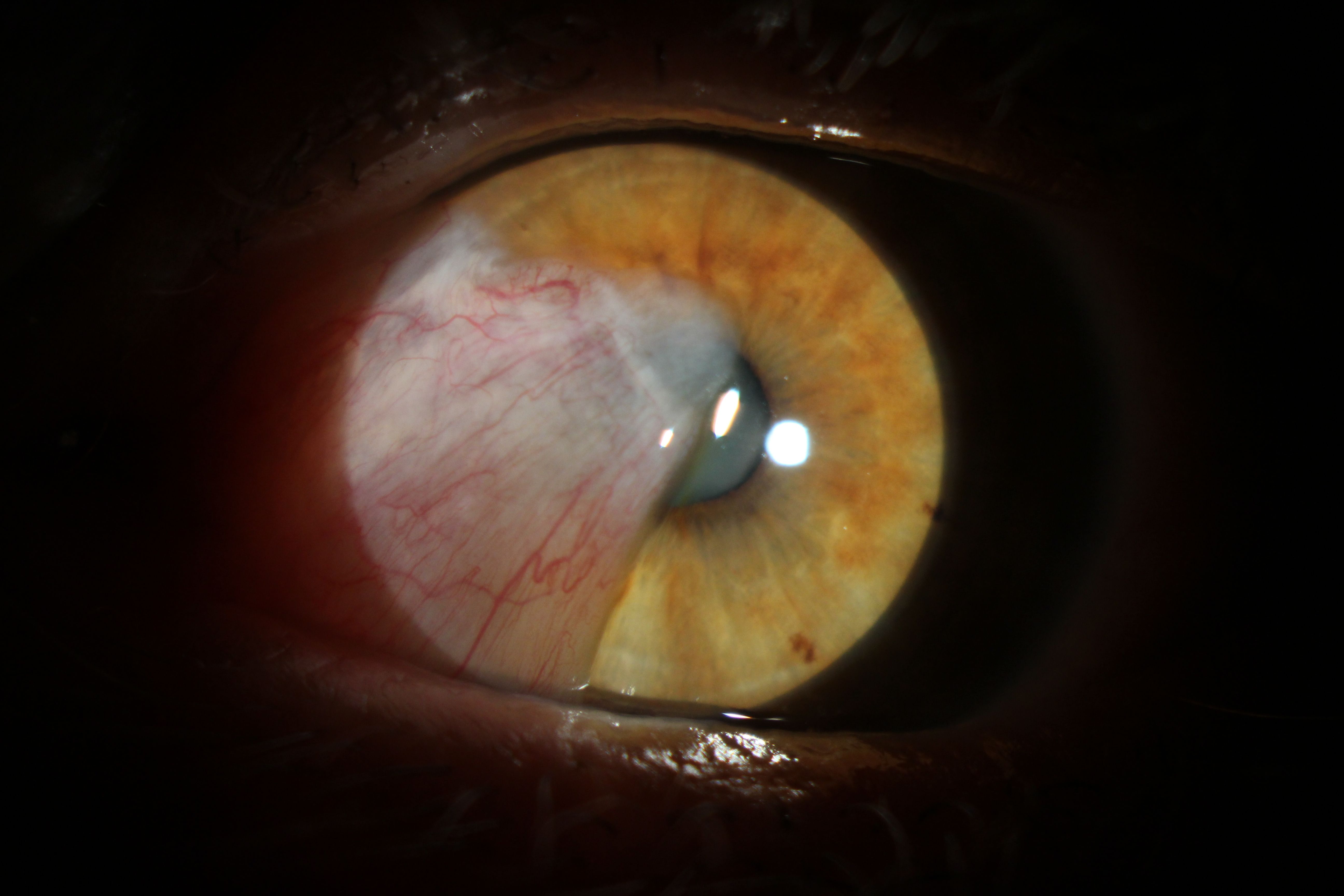 macular oedema after cataract surgery)