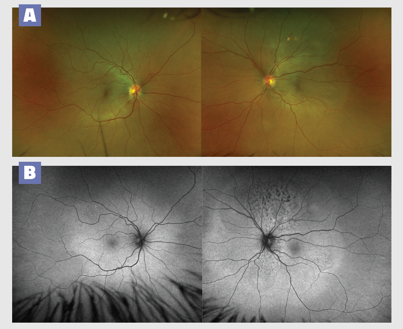 Image courtesy of Oscar Chen, MD, MS; Fred Crawford, MD; and Veena Raiji, MD, MPH