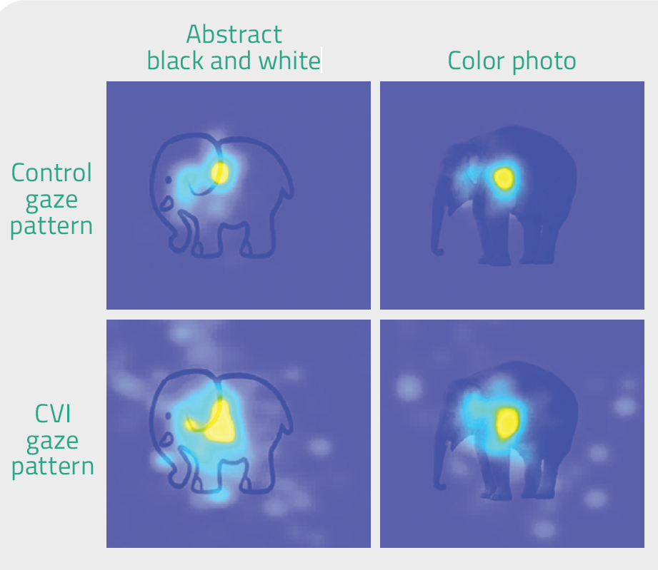 Cerebral visual impairment: Documenting the visual effects and ...