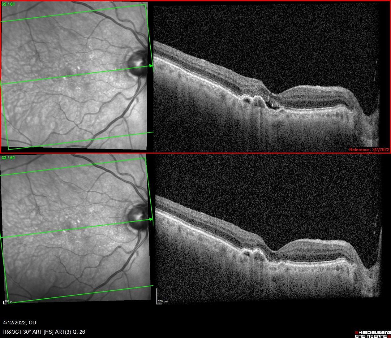 This patient began treatment in 2013, receiving monthly treatment for years and even enrolling in the Merlin study. Vision fluctuates somewhat over the years. The patient recently switched to faricimab (Vabysmo, Genentech), and the imaging shows resolution of fluid while vision was maintained. (Images courtesy of Carl Danzig, MD)