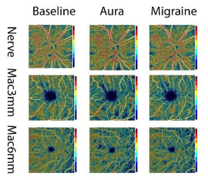 Migraines and retinal perfusion: A headache for physicians, patients