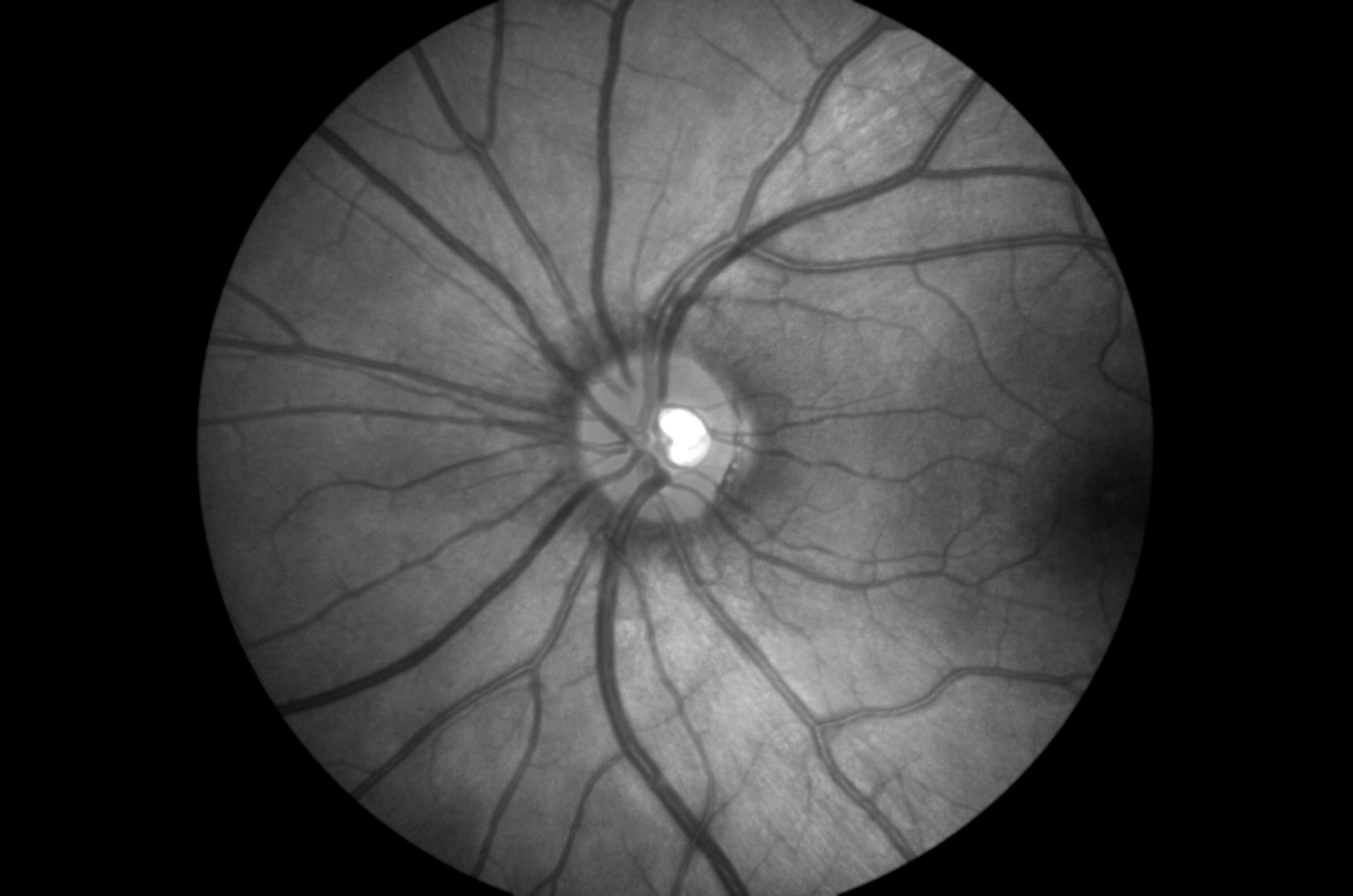 imaging retinal pathology