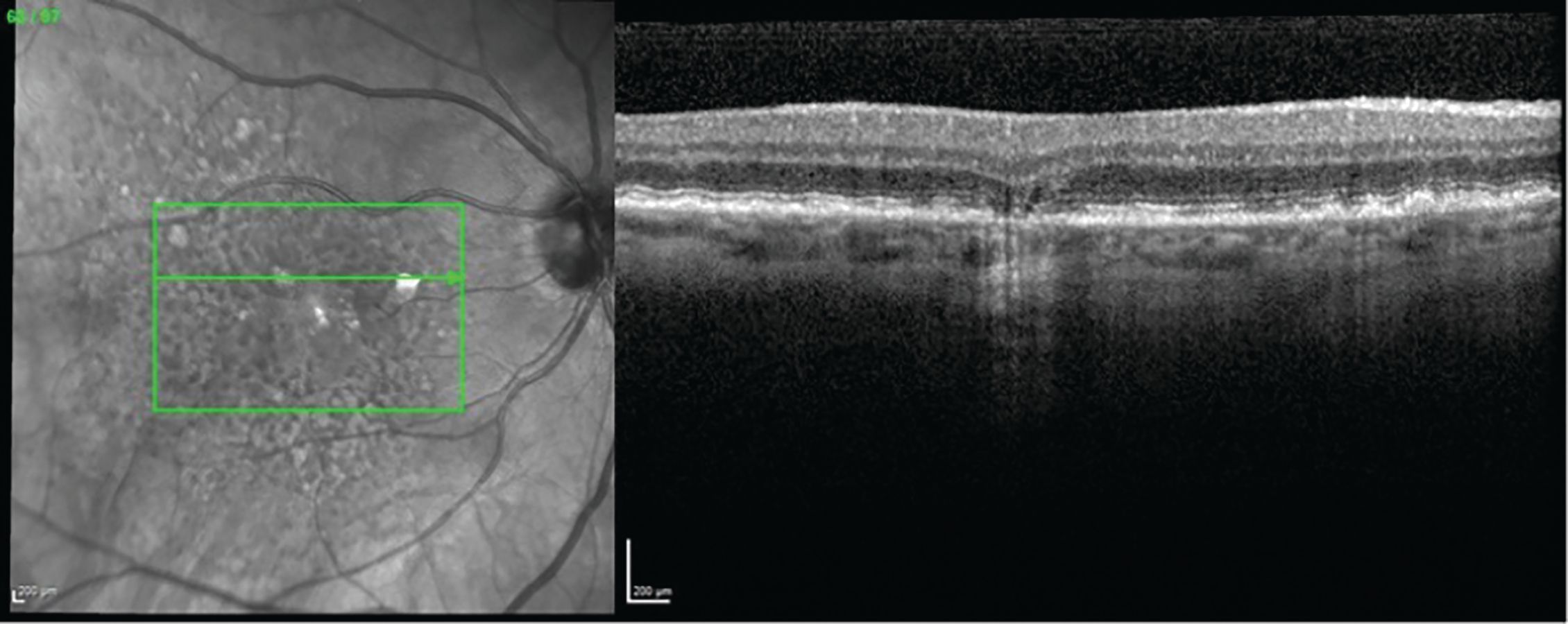 Figure 1. Incomplete retinal pigment epithelium (RPE) and outer retinal atrophy (iRORA).