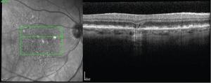 High-resolution multimodal imaging is key in dry AMD therapeutic development, future management