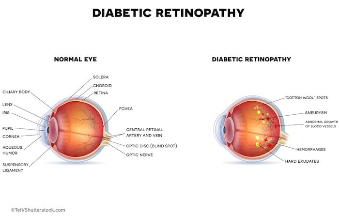 diabetic retinopathy