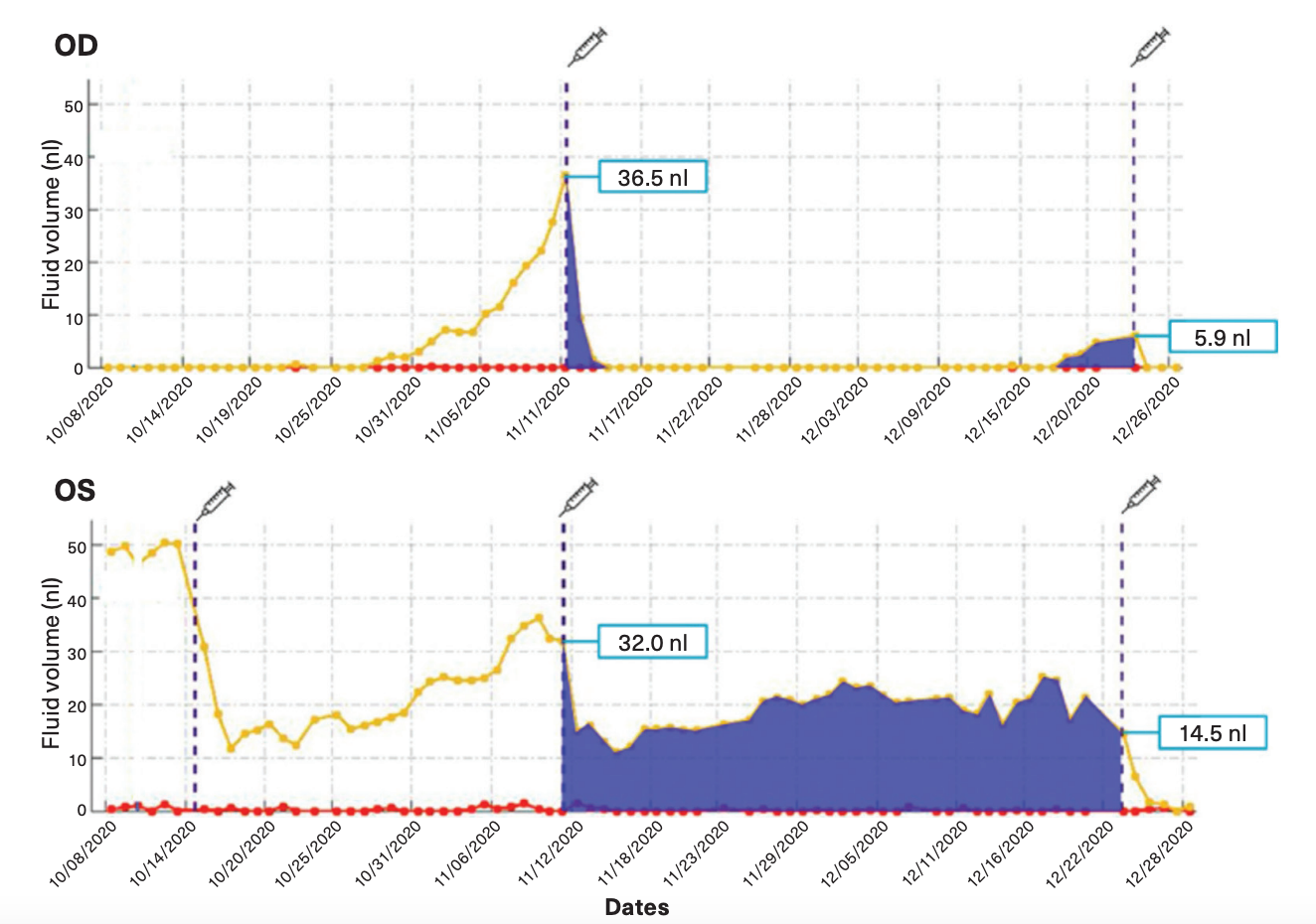 Intraretinal fluid (red) and subretinal fluid (yellow) volume trajectories from Notal OCT Analyzer segmentation of daily Home OCT self-images of a patient’s right and left eyes. Retinal fluid exposure described by the area under the curve between treatments (syringe) differs significantly between eyes despite similar fluid volumes measured on the day of office treatment visits, illustrating the medical insights gained from daily OCT imaging at home. (Data courtesy of Notal Vision Inc)