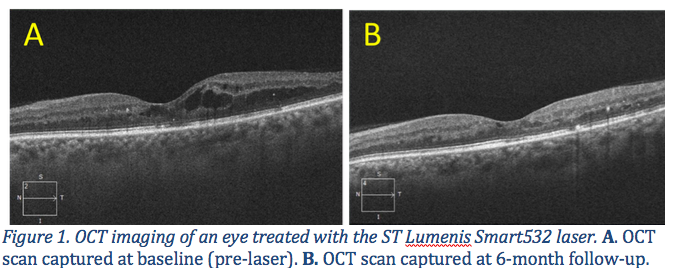 Subthreshold laser may reduce intravitreal injections for DME