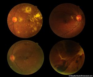 Anti-VEGF injections and glaucoma: Surgeons must watch IOP elevation