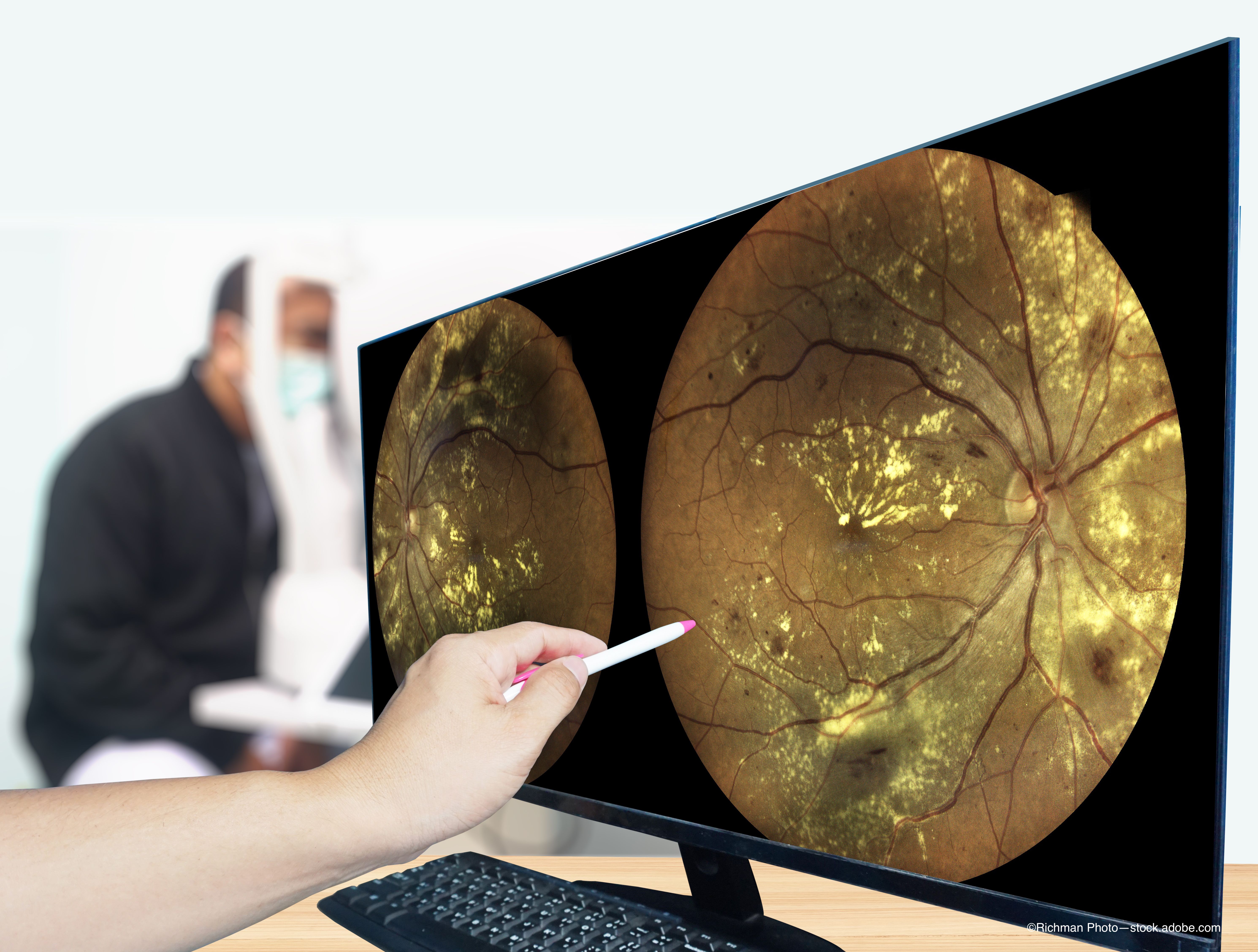 Glaucoma conversion predictor proves faster, cheaper than alternatives