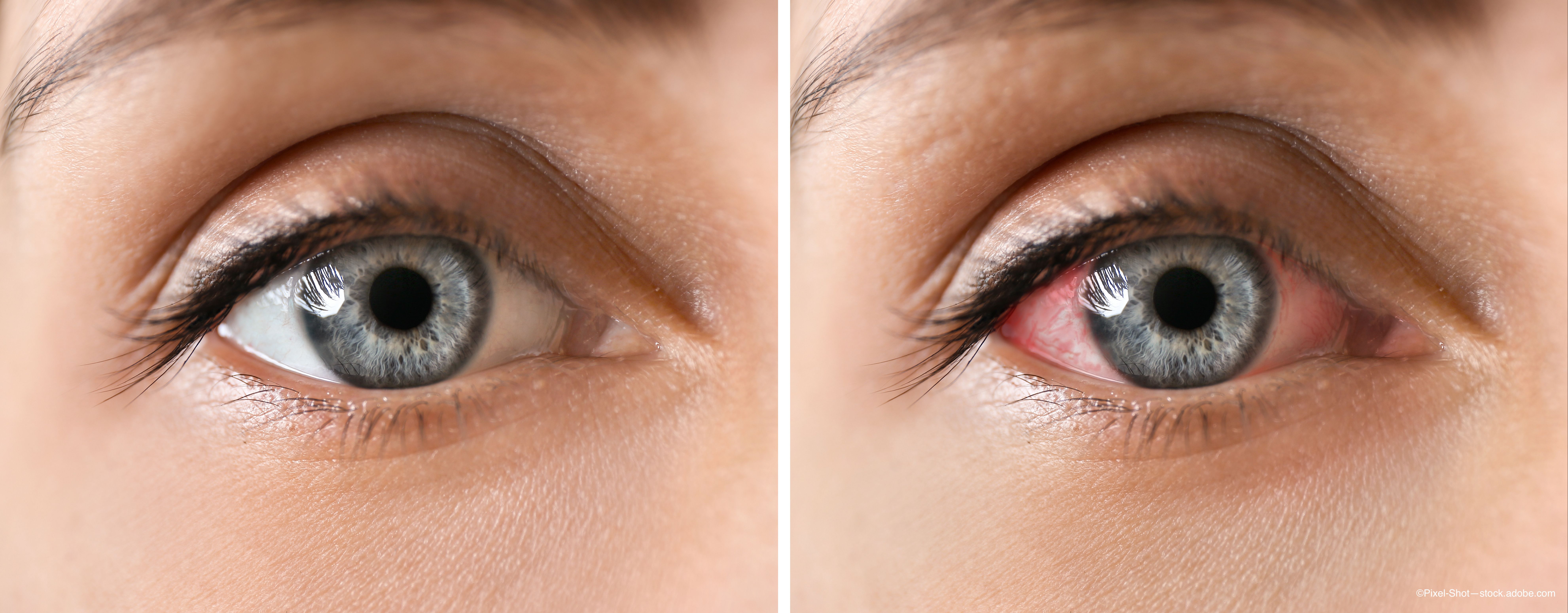 International coalition categorizes 25 subtypes of uveitis using machine learning