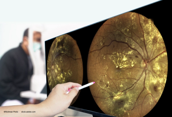 Faricimab: Safe, durable treatment for DME over the long term