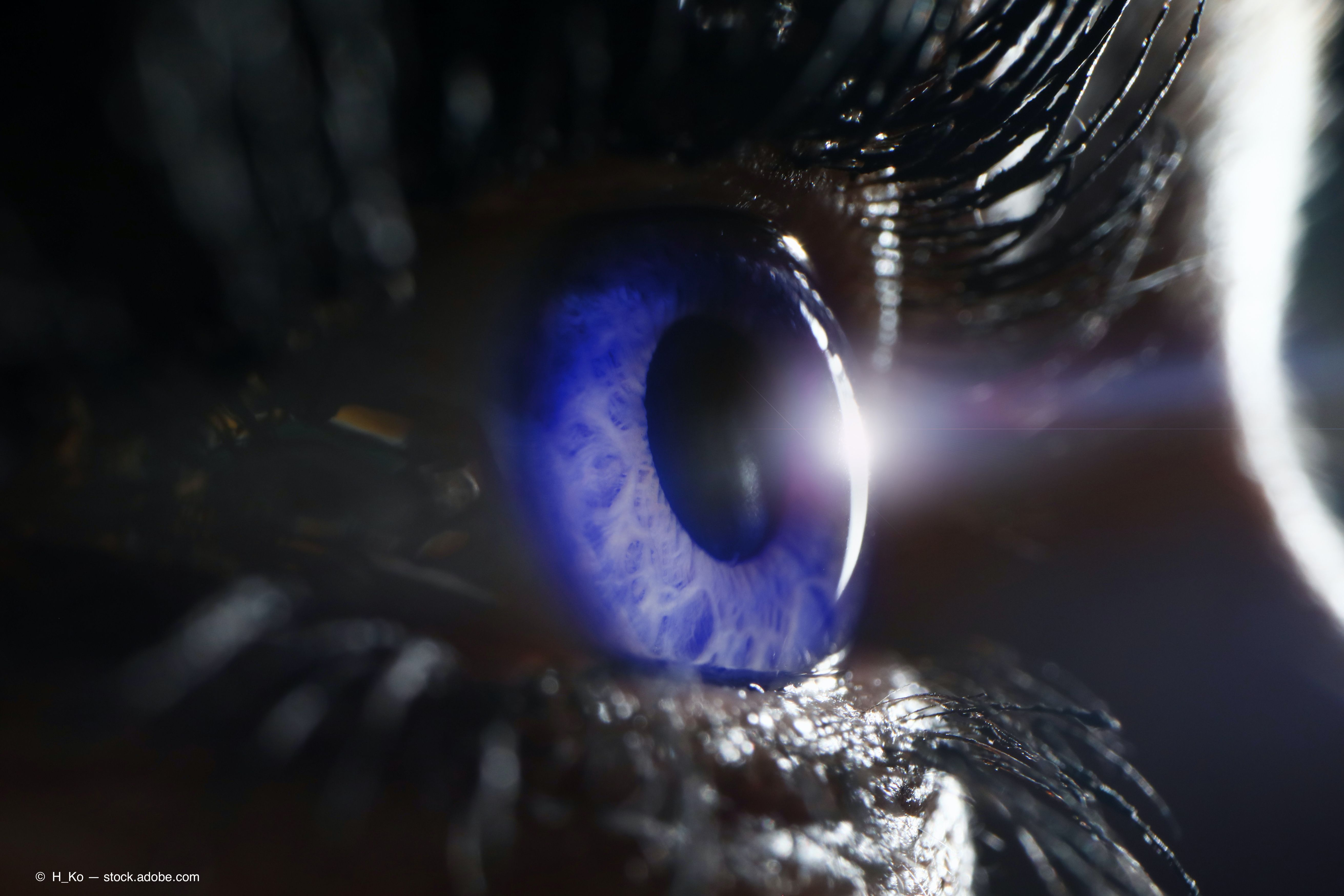 The number of patients with retinal diseases is steadily increasing in the United States, according to a retrospective study presented during ARVO 2020.