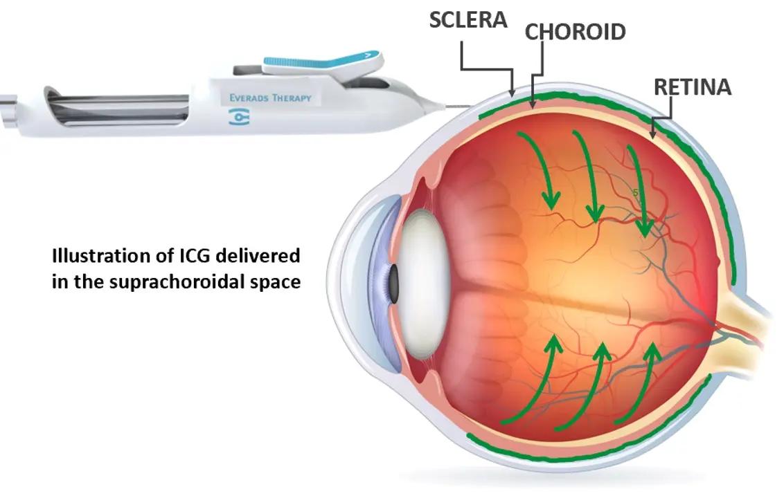 Suprachoroidal injection successfully delivers drug to the macula ...