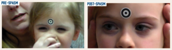 Novel oculomotor characteristics of achromatopsia