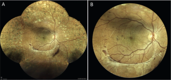 Broadening the benefits of iCare EIDON retinal imaging with the new Ultra-Wide Field Module