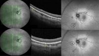 FLORetina 2025: Using multimodal imaging to rethink Terson syndrome