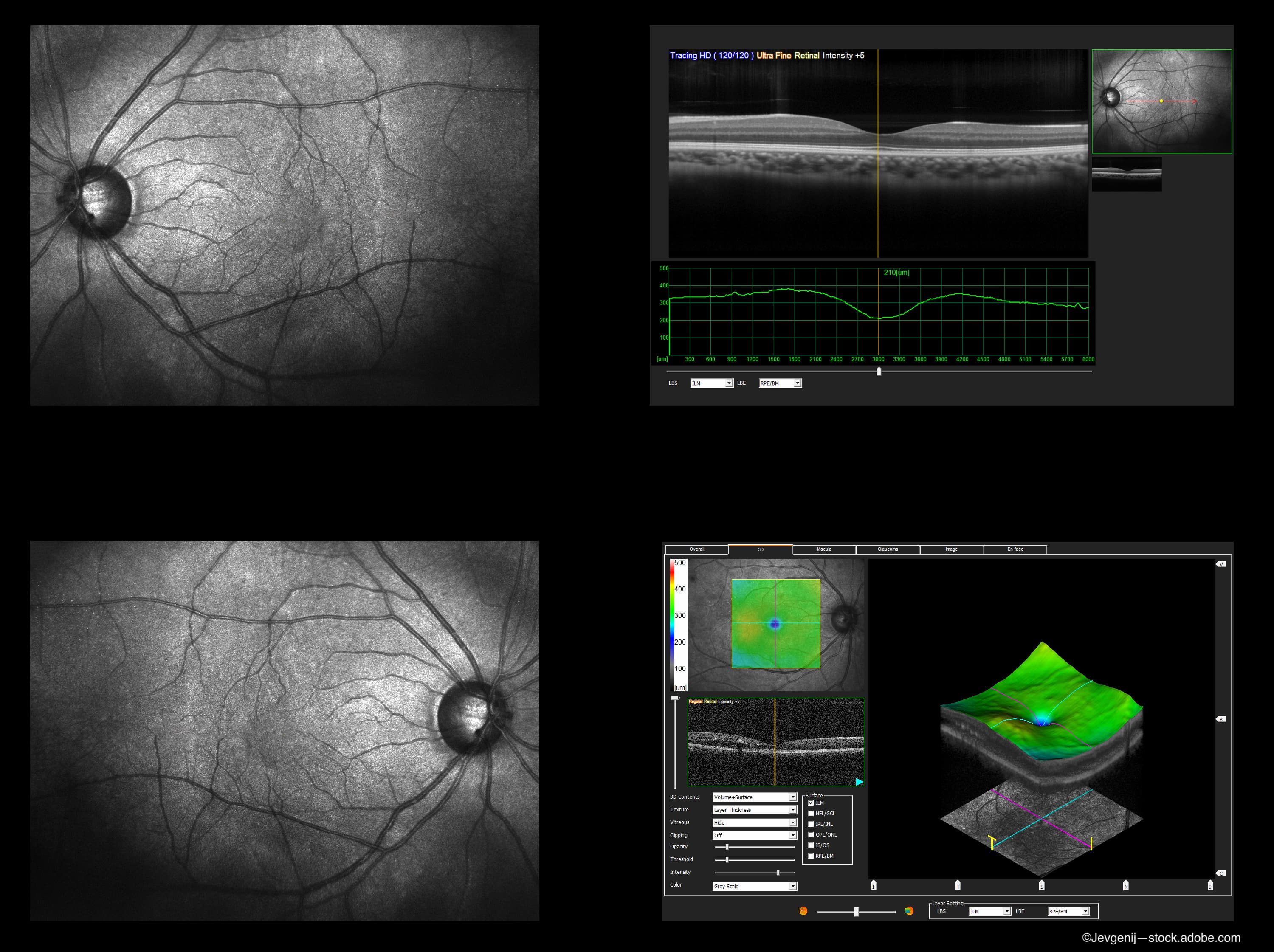 TOWER study: A new index to measure retinal fluid fluctuations in the retina in wet AMD