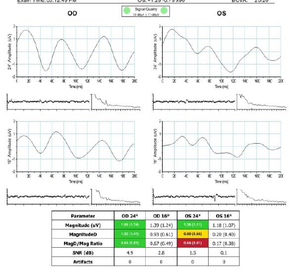 Light induced visual-response: Objective, functional vision testing