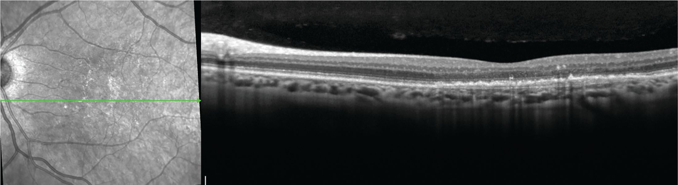 Figure 3. Double layer signs are an important optical coherence tomography (OCT) biomarker.
