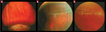 Images courtesy of Leo Semes, OD, FAAO