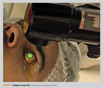 Collagen corneal CXL