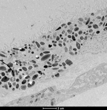 Research reveals genetic signatures of AMD, may lead to improved diagnosis