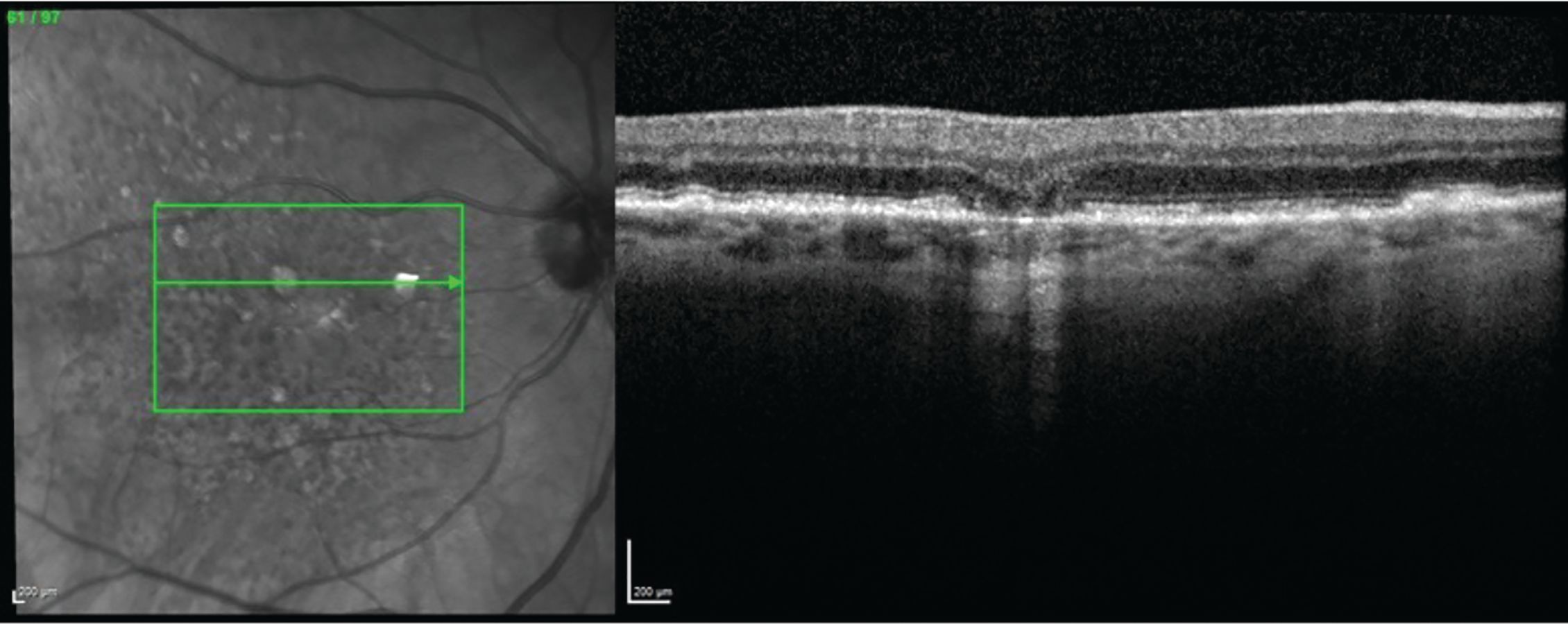 Figure 2. Complete RPE and outer retinal atrophy (cRORA).
