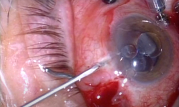 Silicone oil complications mostly manageable