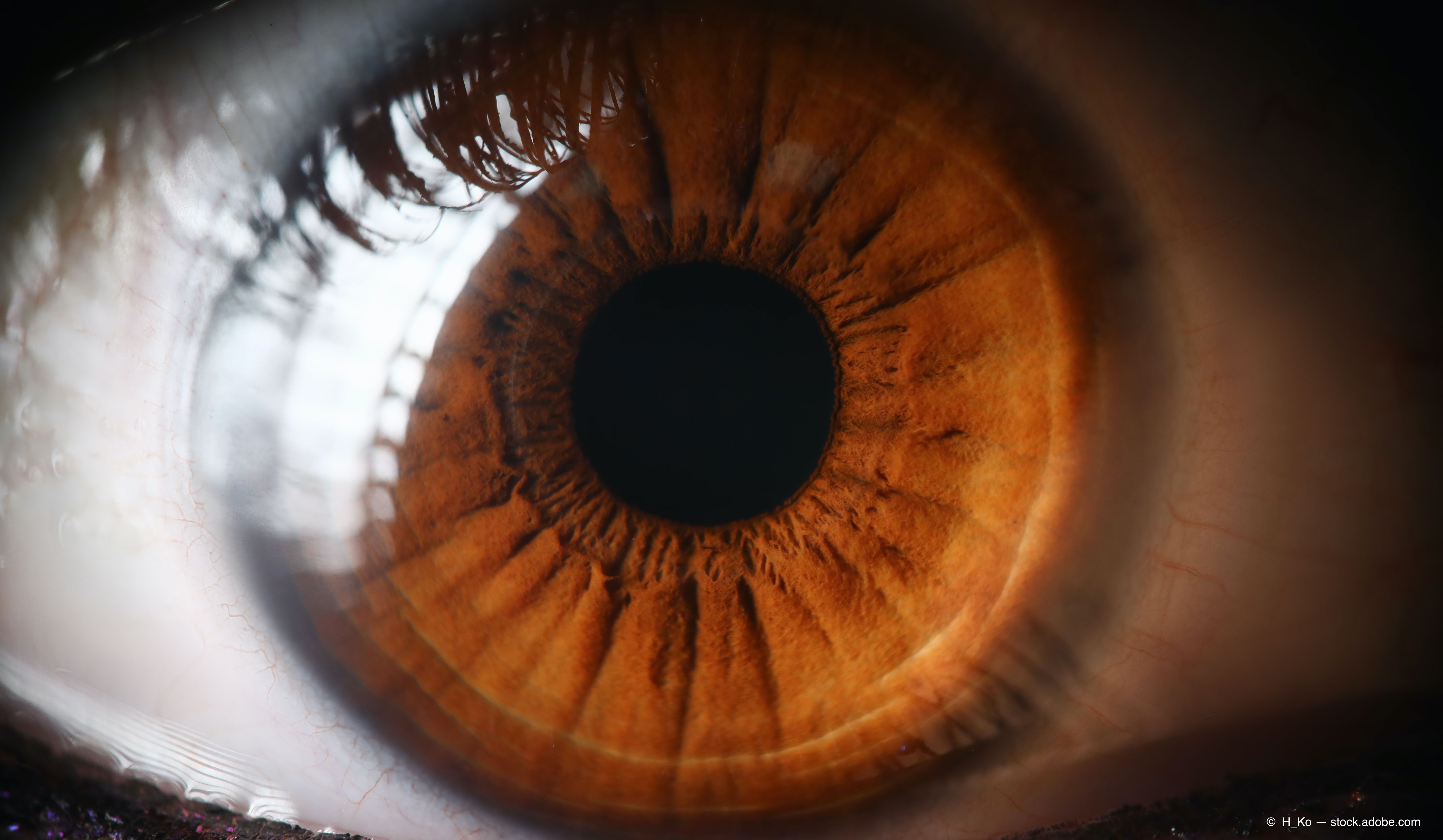 ASRS 2020: Protocol T Extension Study shows long-term visual declines in DME eyes