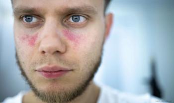 Discovery links lupus and macular degeneration