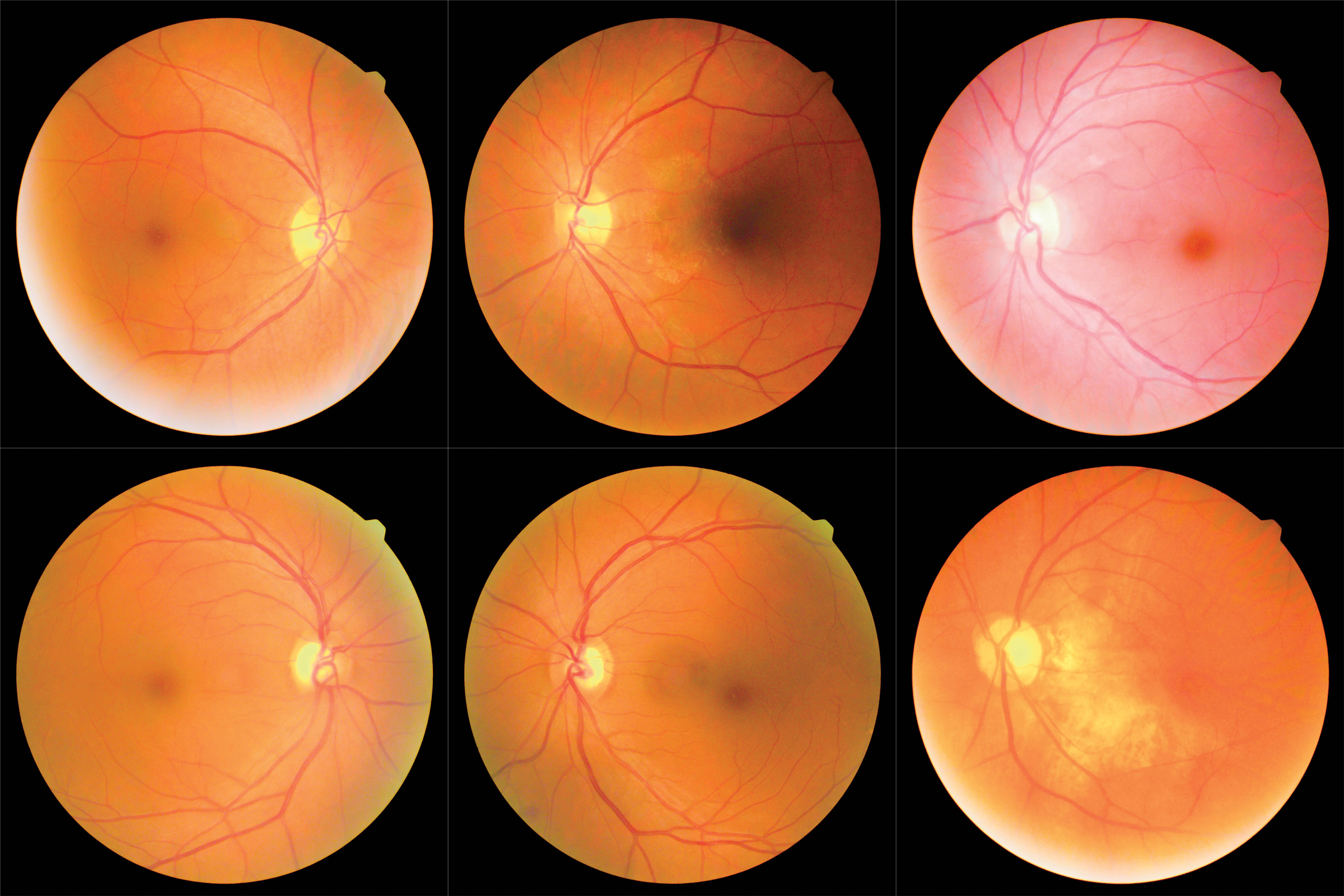 Probe of IRIS Registry shows anti-VEGF injections leading treatment for PDR 