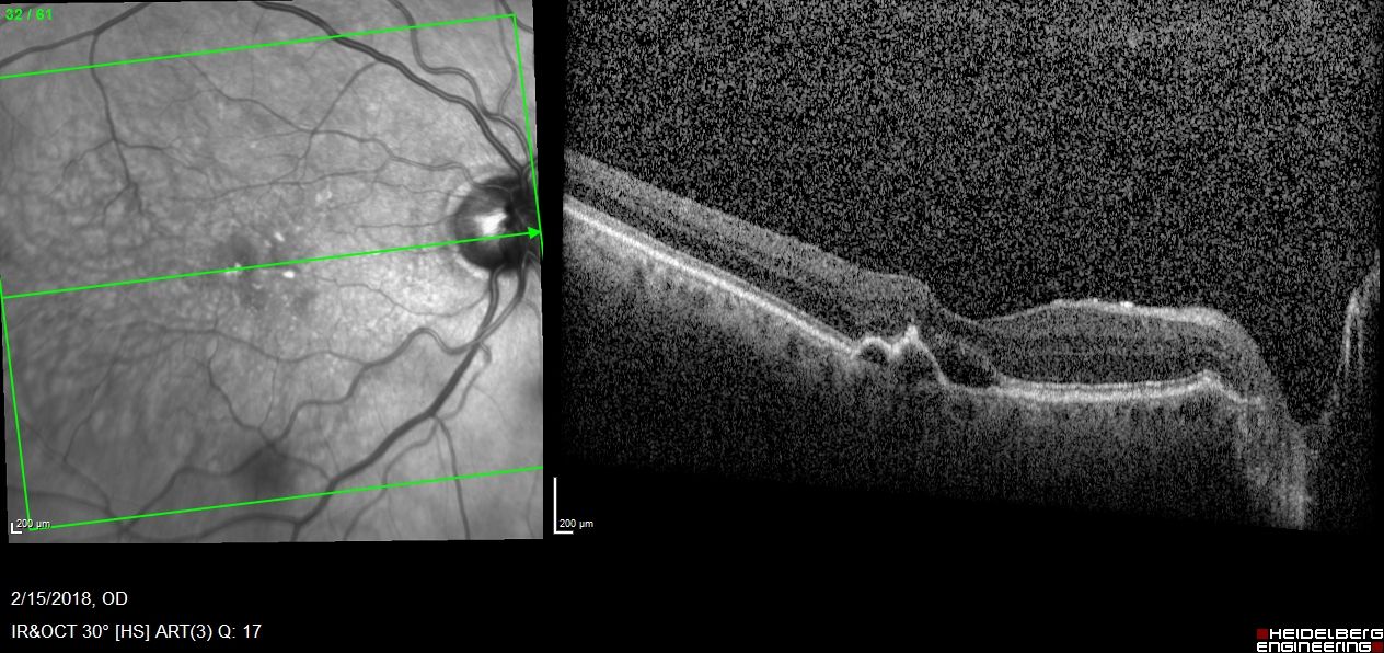 This patient began treatment in 2013, receiving monthly treatment for years and even enrolling in the Merlin study. Vision fluctuates somewhat over the years. The patient recently switched to faricimab (Vabysmo, Genentech), and the imaging shows resolution of fluid while vision was maintained. (Images courtesy of Carl Danzig, MD)