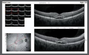 Laser therapy may offer fast-acting option for CSR resolution 