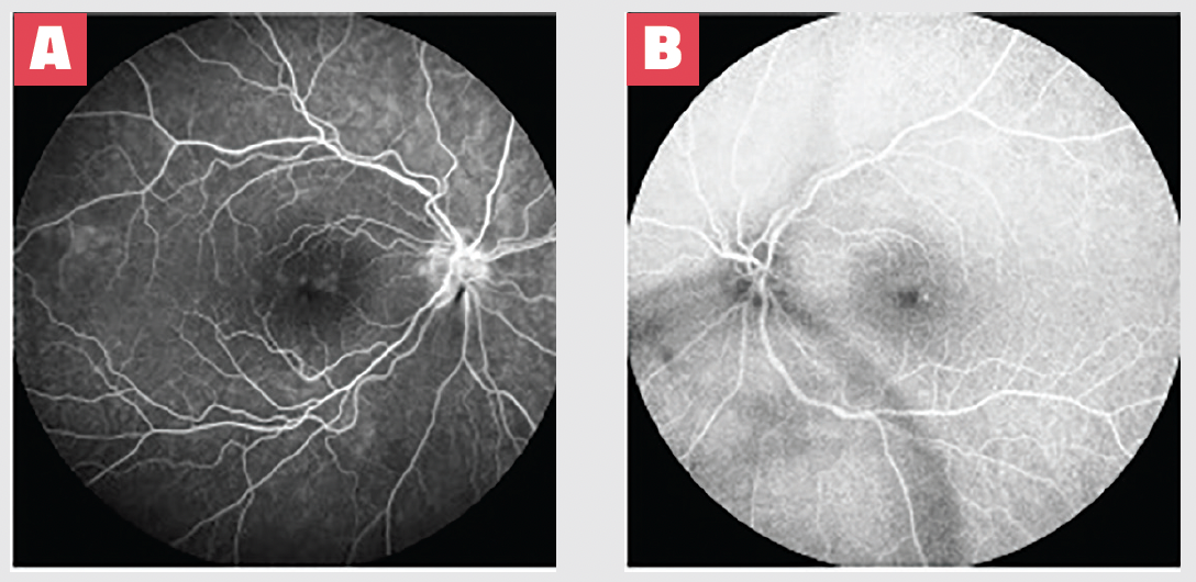 Expanding our vision of steroid-eluting implants