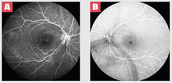 Expanding our vision of steroid-eluting implants