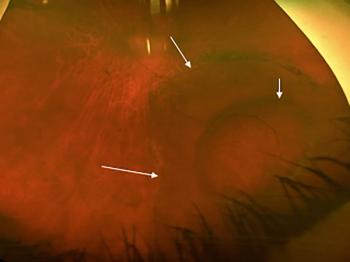 Investigating surgical approaches for progressive retinal detachments secondary to Retinoschisis