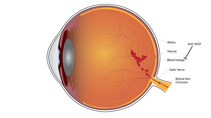 Long-lasting vision improvement linked to treatment for retinal vein occlusion, NEI study finds