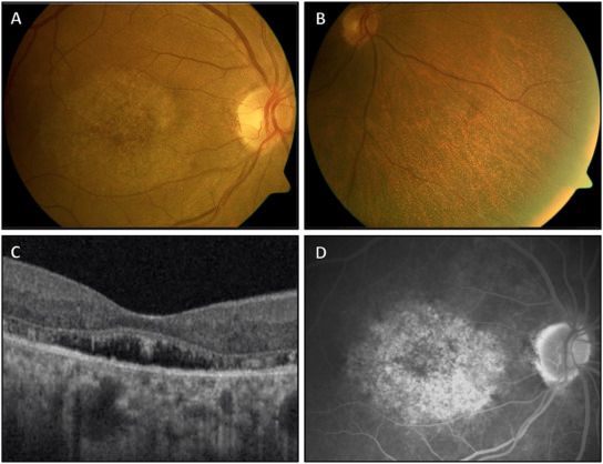 Adaptive optics SLO sheds light on fundus albipunctatus