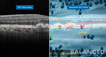 BALANCED Media|Technology, in partnership with the Retina Foundation of the Southwest and SMU, have filed a patent for medical imaging technology that uses automated software and a video game to provide standardized, accurate, and precise identification of ocular diseases including age-related macular degeneration. (Image courtesy of BALANCED Media | Technology)
