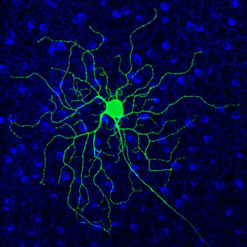 Drug designed to decrease alcohol dependence may save vision for patients with RP, AMD